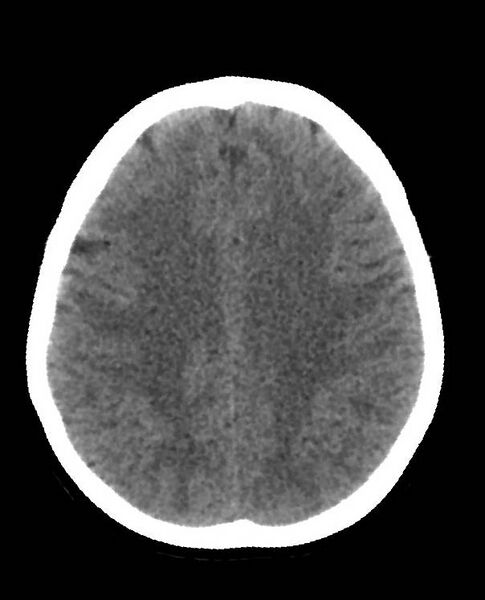File:Cerebral edema due to severe hyponatremia (Radiopaedia 89826-106938 Axial non-contrast 71).jpg