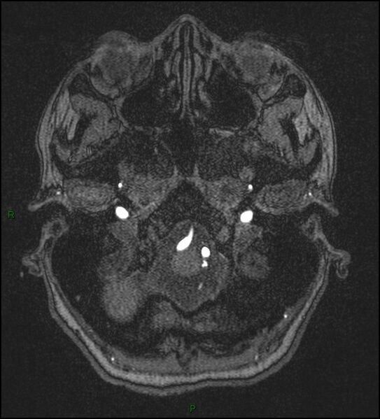 File:Cerebral fat embolism (Radiopaedia 35022-36525 Axial TOF 19).jpg