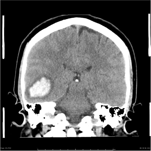 File:Cerebral hemorrhage secondary to arteriovenous malformation (Radiopaedia 33497-34561 Coronal non-contrast 30).jpg