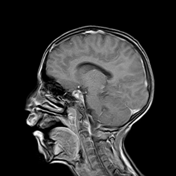 File:Cerebral tuberculoma (Radiopaedia 41152-43932 Sagittal T1 C+ 11).jpg
