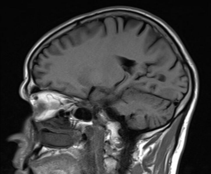 File:Cerebral venous thrombosis (Radiopaedia 71207-81504 Sagittal T1 10).jpg