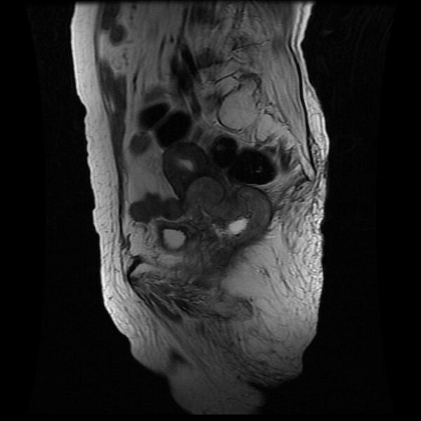 File:Cervical carcinoma (Radiopaedia 78847-91705 Sagittal T2 6).jpg
