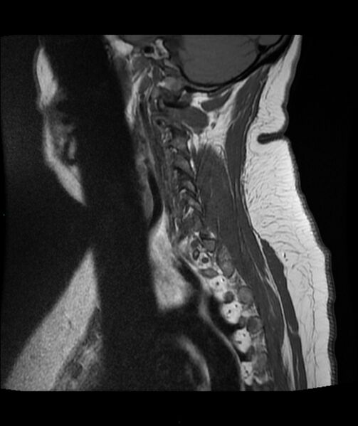 File:Cervical disc prolapse (Radiopaedia 80258-93598 Sagittal T1 14).jpg