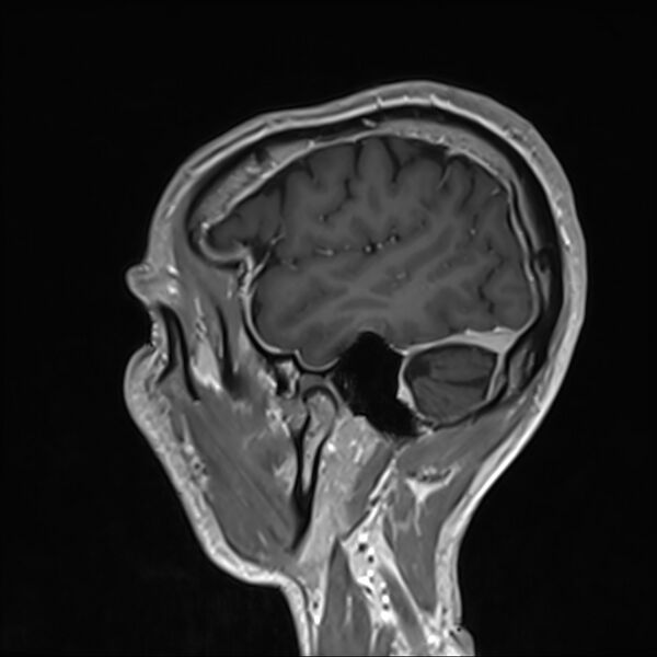 File:Cervical dural CSF leak on MRI and CT treated by blood patch (Radiopaedia 49748-54995 G 105).jpg