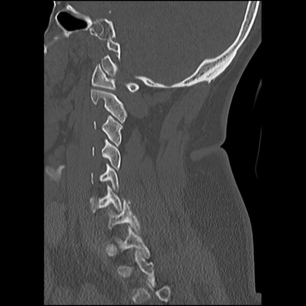 File:Cervical fracture and dislocation with locked facet (Radiopaedia 31837-32780 Sagittal bone window 25).jpg