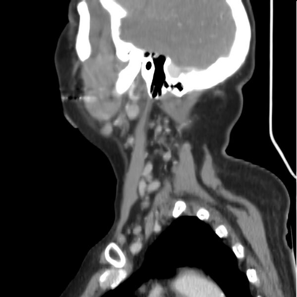 File:Cervical lymphadenopathy- cause unknown (Radiopaedia 22420-22457 D 32).jpg