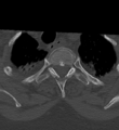 Cervical spine ACDF loosening (Radiopaedia 48998-54070 Axial bone window 60).png