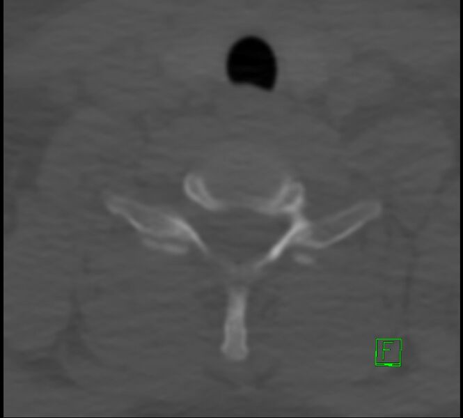File:Cervical spine fracture - hyperflexion injury (Radiopaedia 66184-75364 Axial bone window 44).jpg