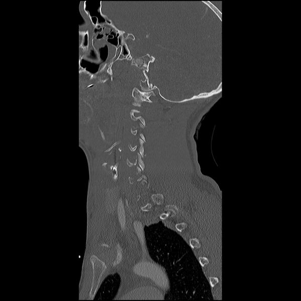 File:Cervical spine fractures with vertebral artery dissection (Radiopaedia 32135-33078 Sagittal bone window 33).jpg