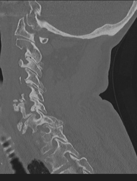 File:Cervical spondylolysis (Radiopaedia 49616-54811 Sagittal bone window 47).png