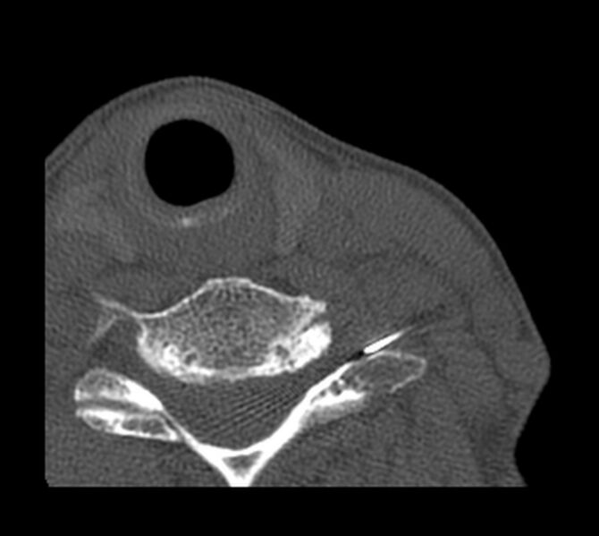 File:Cervical transforaminal epidural steroid injection (CT-guided) (Radiopaedia 75220-86318 Axial bone window 4).jpg