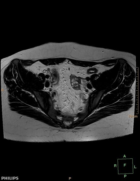 File:Cesarian scar endometriosis (Radiopaedia 68495-78066 Axial T2 7).jpg