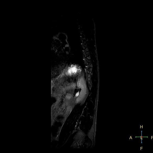 File:Chance fracture of T12 (Radiopaedia 24313-24588 Sagittal STIR 1).jpg