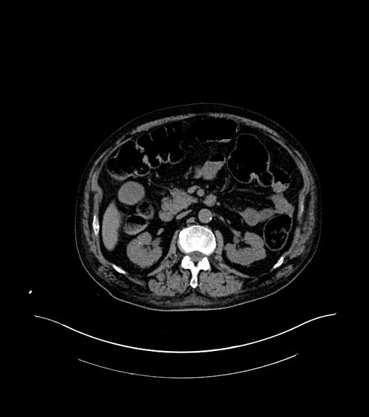 File:Cholangiocarcinoma with cerebral metastases (Radiopaedia 83519-98629 Axial non-contrast 42).jpg