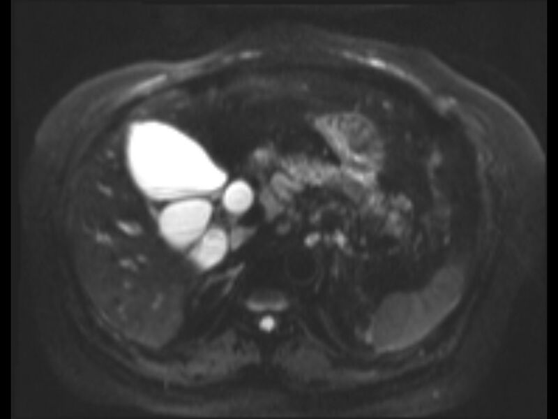 File:Choledocholithiasis causing intrahepatic biliary duct dilation (Radiopaedia 39908-42369 Axial T2 SPAIR 18).jpg