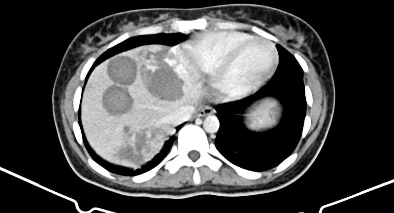 File:Choriocarcinoma liver metastases (Radiopaedia 74768-85766 A 26).jpg