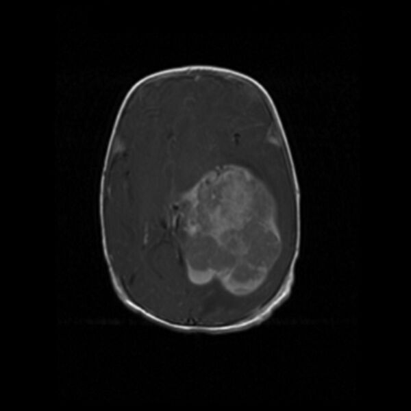 File:Choroid plexus carcinoma (Radiopaedia 21121-21035 Axial T1 C+ 10).jpg