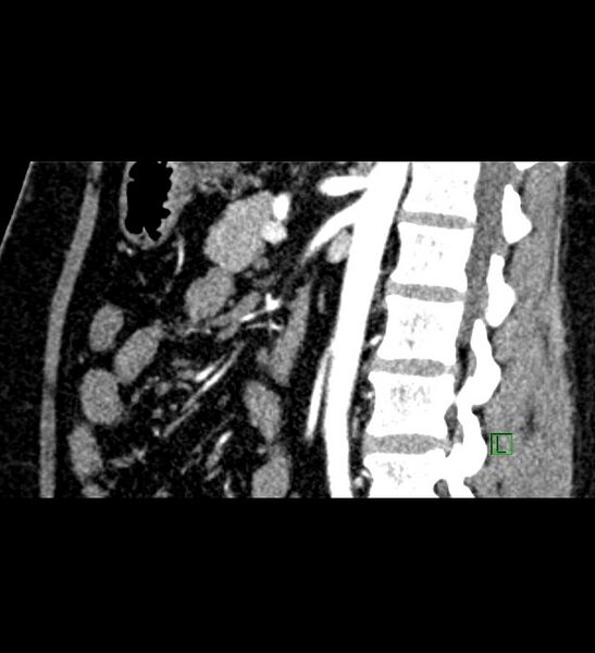 File:Chromophobe renal cell carcinoma (Radiopaedia 84286-99573 F 77).jpg