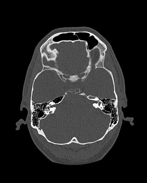 File:Chronic maxillary sinusitis caused by a foreign body (Radiopaedia 58521-65676 Axial bone window 257).jpg
