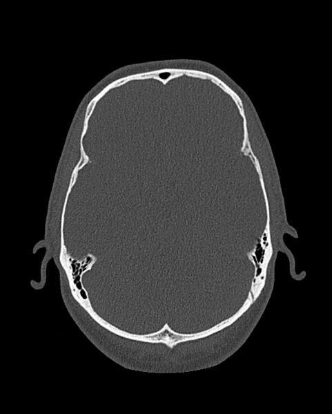 File:Chronic maxillary sinusitis caused by a foreign body (Radiopaedia 58521-65676 Axial bone window 305).jpg