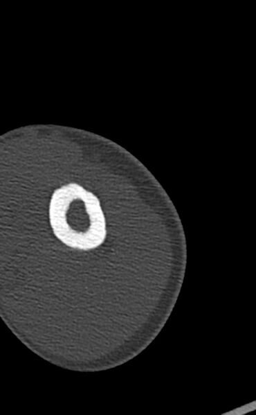 File:Chronic osteomyelitis of the distal humerus (Radiopaedia 78351-90971 Axial 97).jpg