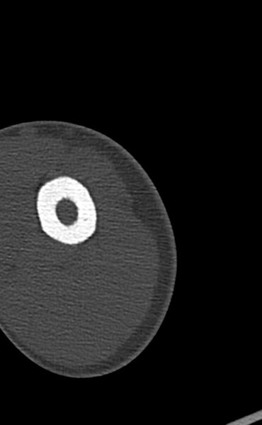 File:Chronic osteomyelitis of the distal humerus (Radiopaedia 78351-90971 Axial bone window 15).jpg