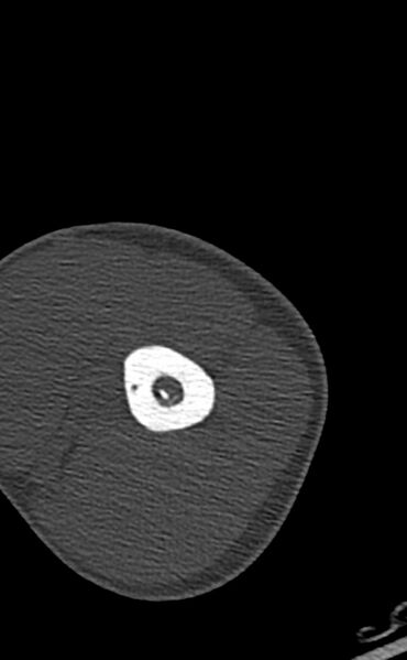File:Chronic osteomyelitis of the distal humerus (Radiopaedia 78351-90971 Axial bone window 38).jpg