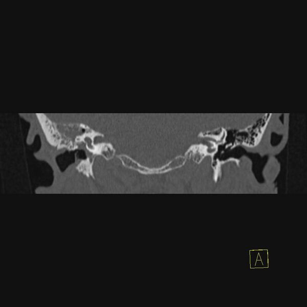 File:Chronic otitis media (Radiopaedia 14994-14912 Coronal bone window 8).JPEG