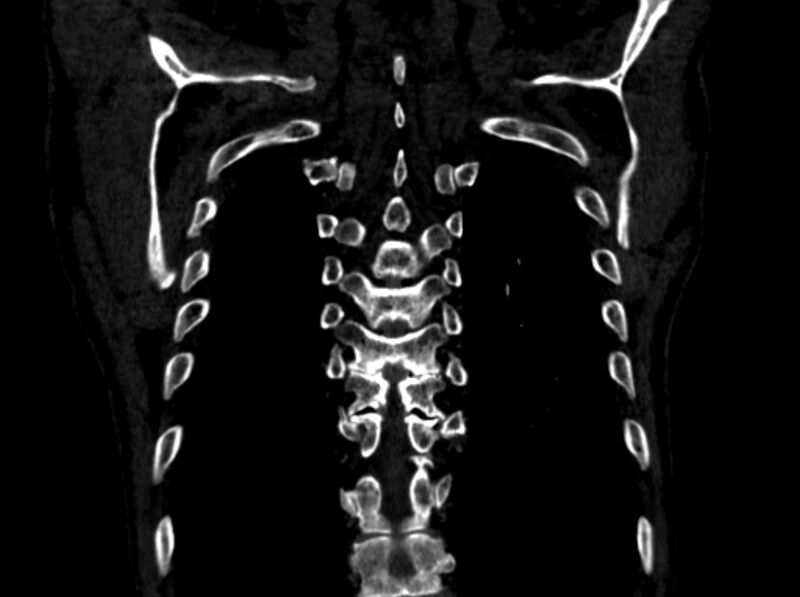 File:Chronic pulmonary embolism (Radiopaedia 91241-108843 A 100).jpg