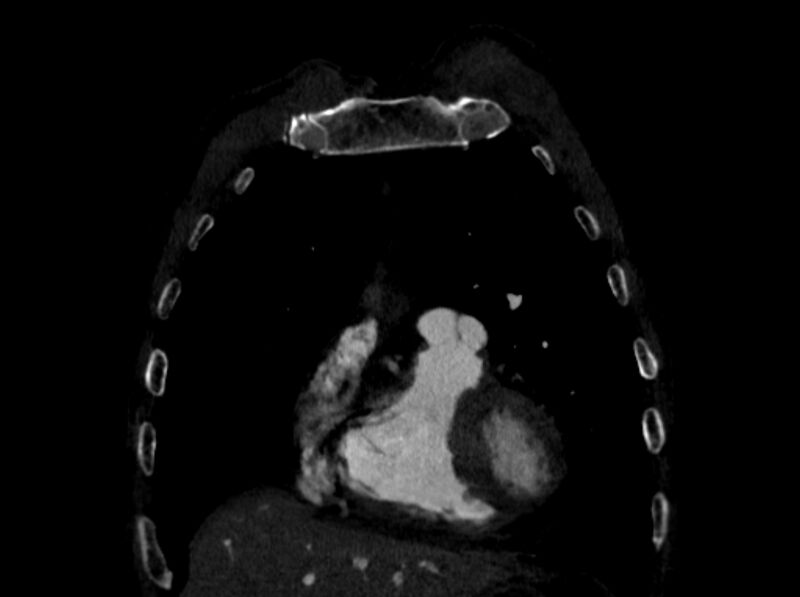 File:Chronic pulmonary embolism (Radiopaedia 91241-108843 A 15).jpg