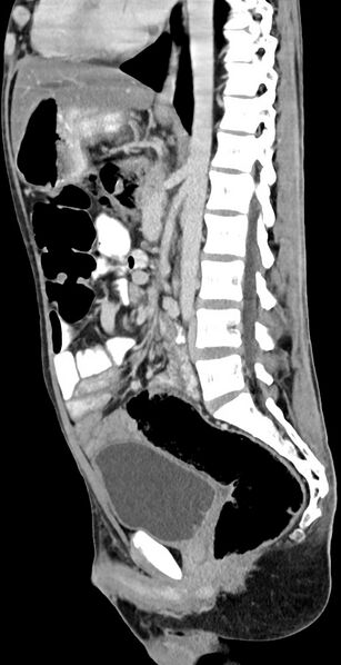 File:Chronic small bowel volvulus (Radiopaedia 75224-86322 C 71).jpg