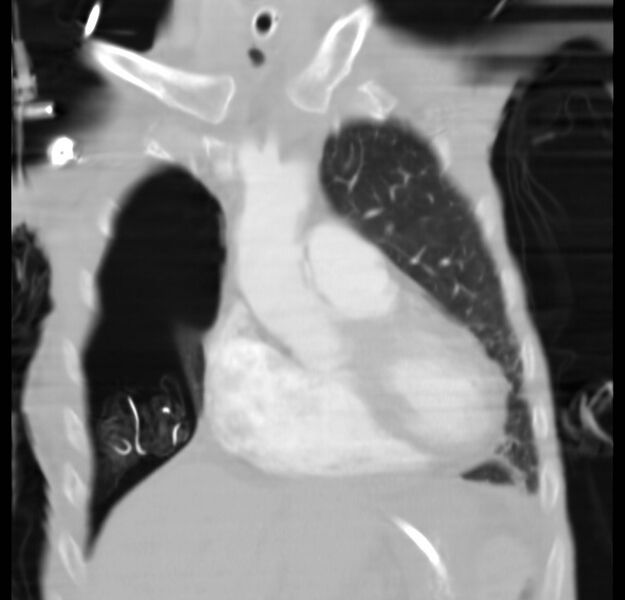File:Clagett thoracotomy with bronchopleural fistula (Radiopaedia 29192-29587 Coronal lung window 23).jpg