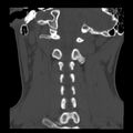 Clay-shoveler fracture (Radiopaedia 22568-22590 Coronal bone window 23).jpg