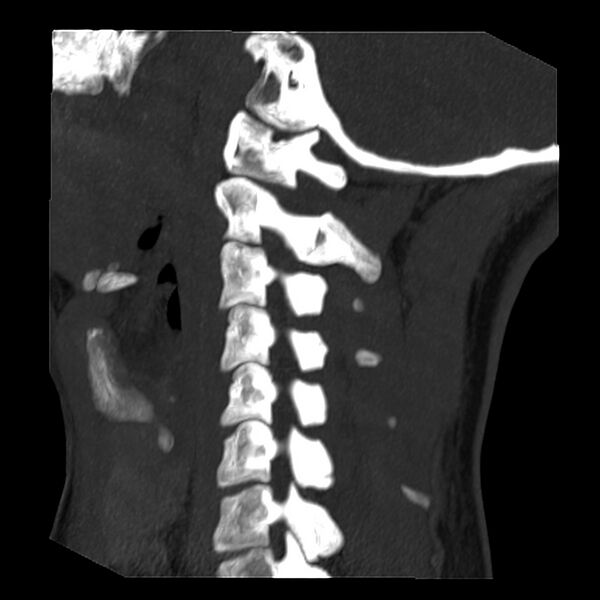 File:Clay-shoveler fracture (Radiopaedia 22568-22590 Sagittal MIP 6).jpg