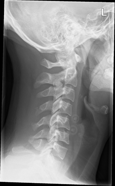 File:Clay-shoveler fracture (Radiopaedia 33847-35012 Lateral 1).png