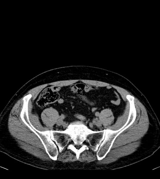 File:Clear cell renal cell carcinoma (Radiopaedia 85006-100539 Axial non-contrast 67).jpg