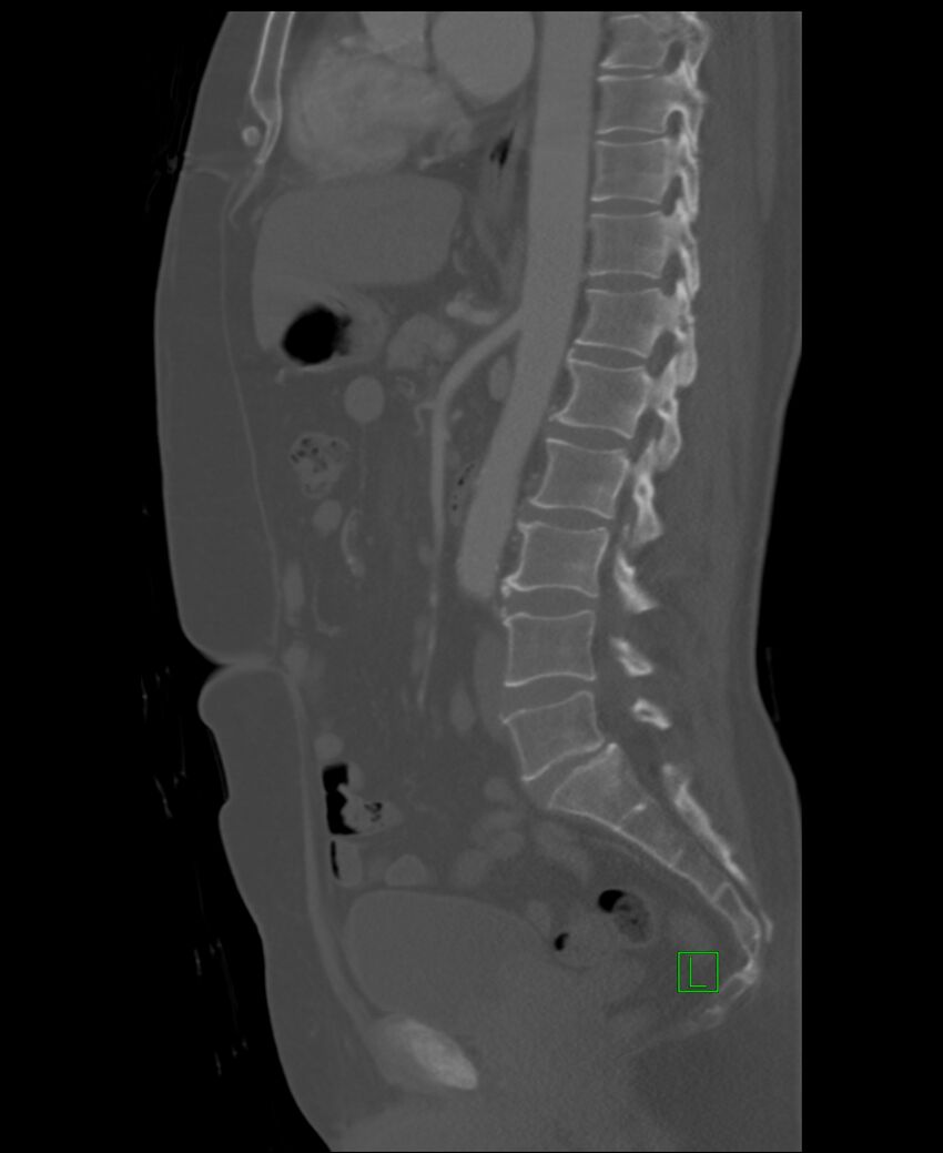 Clear cell renal cell carcinoma (Radiopaedia 85006-100539 Sagittal bone window 29).jpg