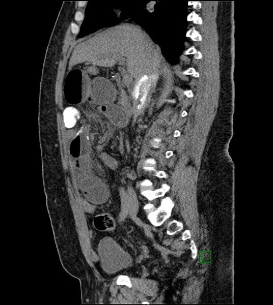 File:Closed-loop small bowel obstruction-internal hernia (Radiopaedia 78439-91096 C 86).jpg