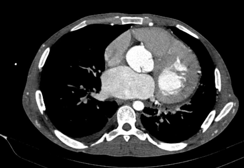 File:Coarctation of aorta with aortic valve stenosis (Radiopaedia 70463-80574 A 121).jpg