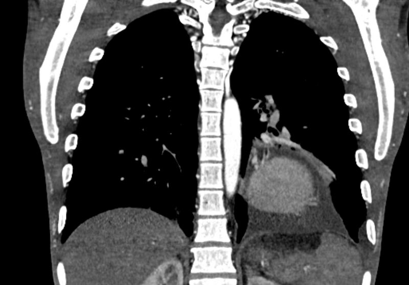 File:Coarctation of aorta with aortic valve stenosis (Radiopaedia 70463-80574 C 173).jpg