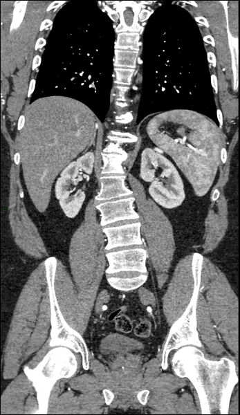 File:Coarctation of the aorta (Radiopaedia 74632-88521 B 159).jpg