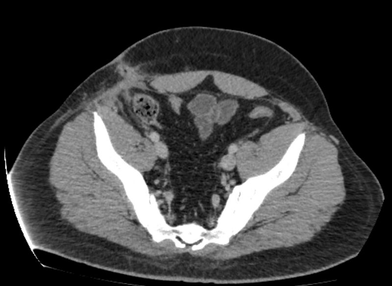 File:Colocutaneous fistula (Radiopaedia 56401-63062 A 78).jpg