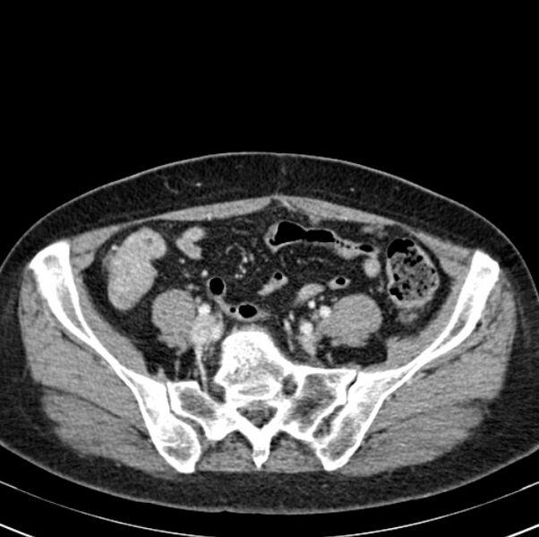 File:Colon carcinoma with hepatic metastases (Radiopaedia 29477-29961 A 84).jpg
