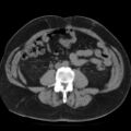 Colonic fistula (Radiopaedia 16047-15707 Axial non-contrast 30).jpg