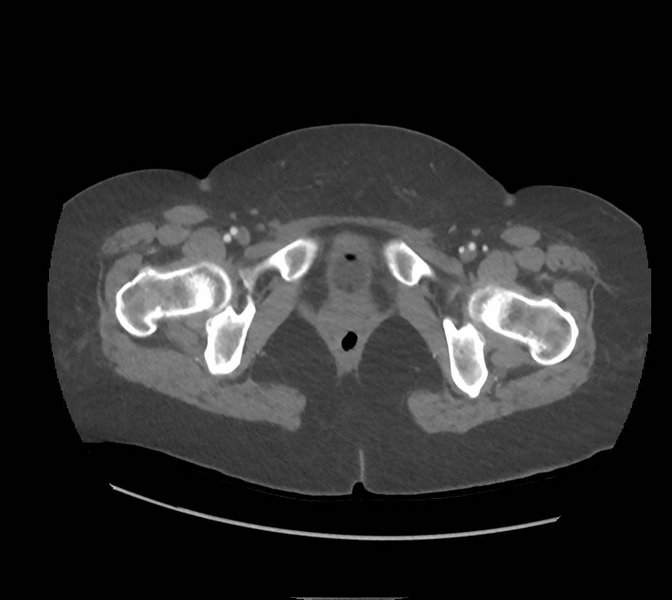 File:Colonic pseudo-obstruction (Radiopaedia 79752-92980 A 188).png