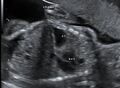 Congenital diaphragmatic hernia (Radiopaedia 36006).jpg