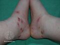 Infected leech bites (DermNet NZ bacterial-leech-bites).jpg