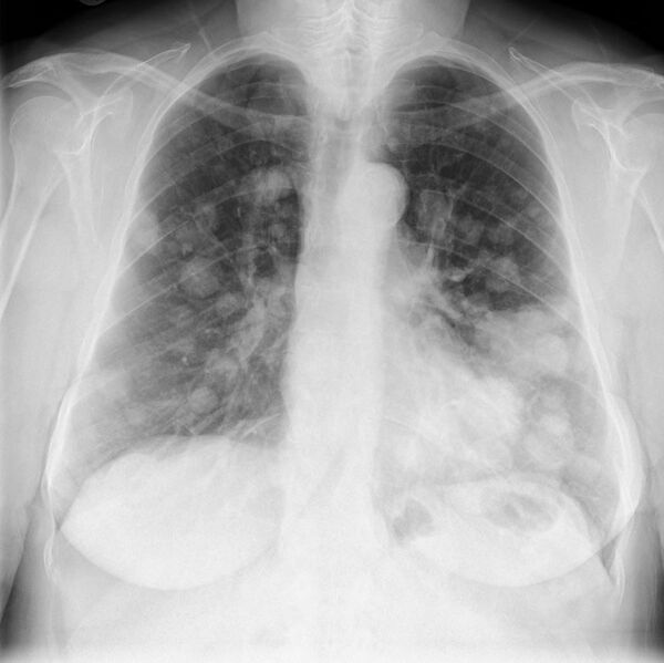 File:Lung metastases - thyroid primary (Radiopaedia 80250).jpg