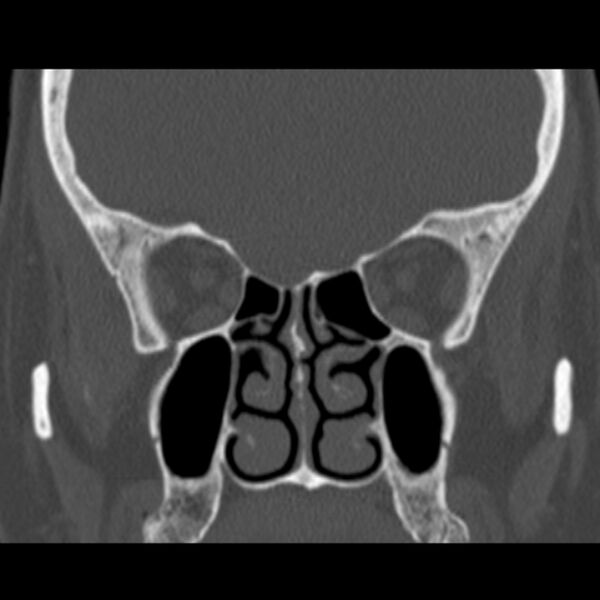 File:Nasolabial cyst (Radiopaedia 33987-35205 Coronal bone window 42).jpg