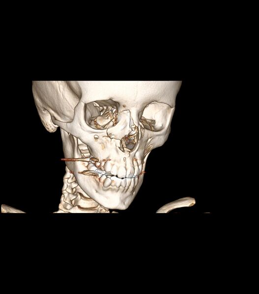 File:Nasoorbitoethmoid fracture (Radiopaedia 90044-107205 3D VRT 14).jpg
